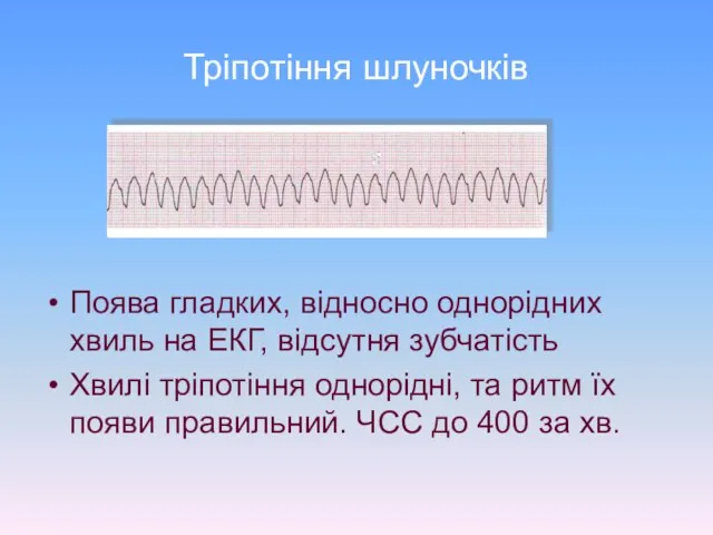 Тріпотіння шлуночків Поява гладких, відносно однорідних хвиль на ЕКГ, відсутня зубчатість