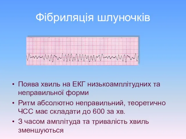 Фібриляція шлуночків Поява хвиль на ЕКГ низькоамплітудних та неправильної форми Ритм