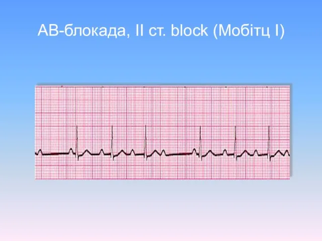 AВ-блокада, ІІ ст. block (Mобітц I)