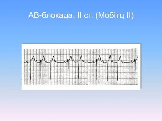 АВ-блокада, ІІ ст. (Мобітц ІІ)