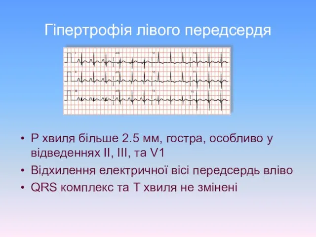 Гіпертрофія лівого передсердя P хвиля більше 2.5 мм, гостра, особливо у