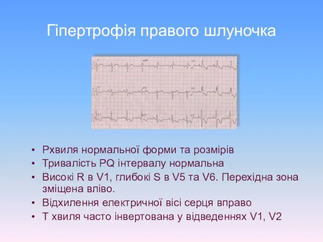 Гіпертрофія правого шлуночка Pхвиля нормальної форми та розмірів Тривалість PQ інтервалу