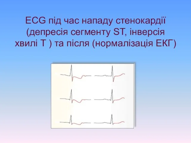 ECG під час нападу стенокардії (депресія сегменту ST, інверсія хвилі T ) та після (нормалізація ЕКГ)