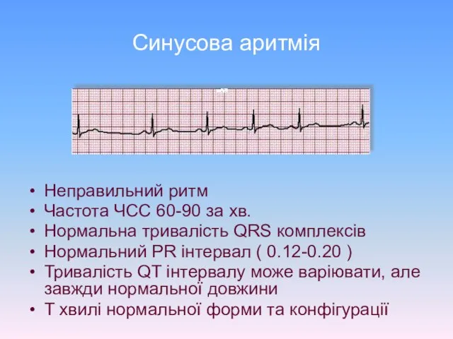 Синусова аритмія Неправильний ритм Частота ЧСС 60-90 за хв. Нормальна тривалість