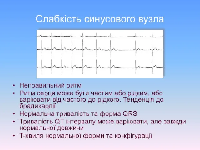 Слабкість синусового вузла Неправильний ритм Ритм серця може бути частим або