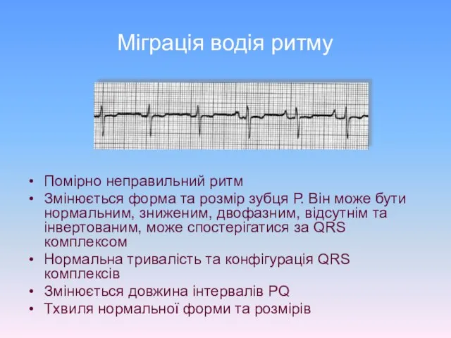 Міграція водія ритму Помірно неправильний ритм Змінюється форма та розмір зубця