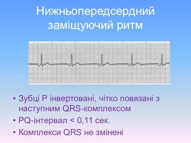 Нижньопередсердний заміщуючий ритм Зубці P інвертовані, чітко повязані з наступним QRS-комплексом PQ-інтервал Комплекси QRS не змінені