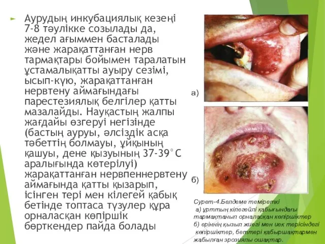 Аурудың инкубациялық кезеңі 7-8 тәулікке созылады да, жедел ағыммен басталады және