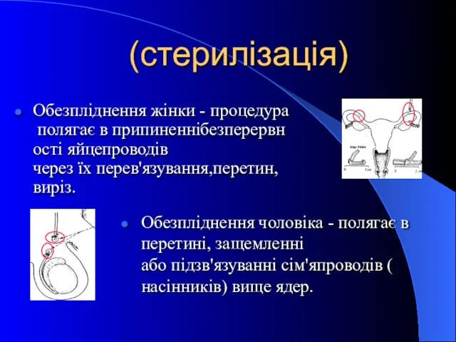 (стерилізація) Обезпліднення жінки - процедура полягає в припиненнібезперервності яйцепроводів через їх