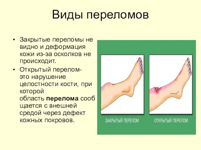 Виды переломов Закрытые переломы не видно и деформация кожи из-за осколков