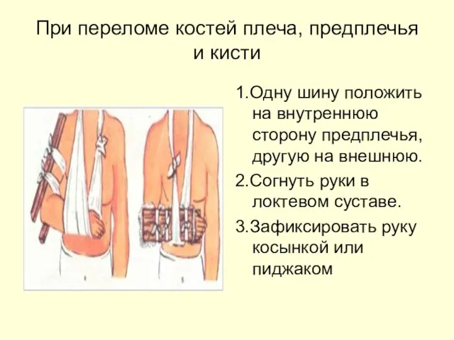 При переломе костей плеча, предплечья и кисти 1.Одну шину положить на