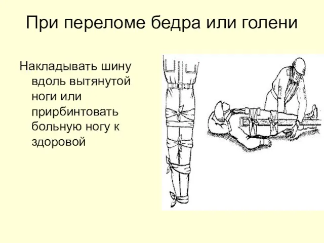 При переломе бедра или голени Накладывать шину вдоль вытянутой ноги или прирбинтовать больную ногу к здоровой
