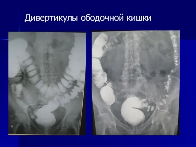 Дивертикулы ободочной кишки