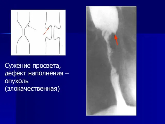 Сужение просвета, дефект наполнения – опухоль (злокачественная)