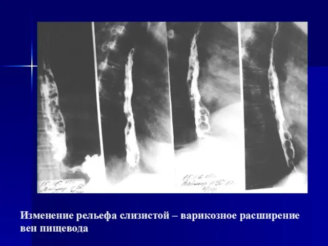 Изменение рельефа слизистой – варикозное расширение вен пищевода