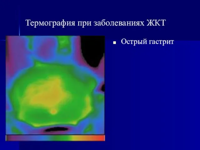 Термография при заболеваниях ЖКТ Острый гастрит