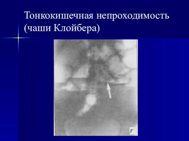 Тонкокишечная непроходимость (чаши Клойбера)