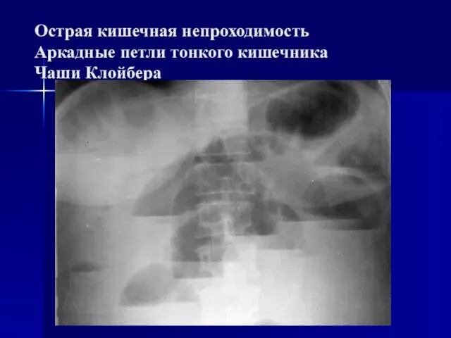 Острая кишечная непроходимость Аркадные петли тонкого кишечника Чаши Клойбера