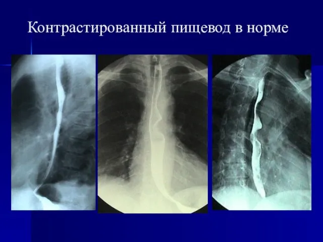 Контрастированный пищевод в норме