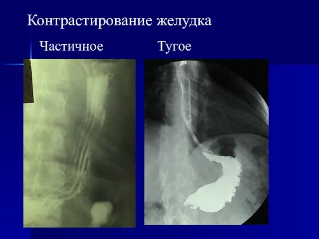 Контрастирование желудка Частичное Тугое