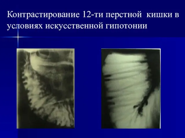 Контрастирование 12-ти перстной кишки в условиях искусственной гипотонии