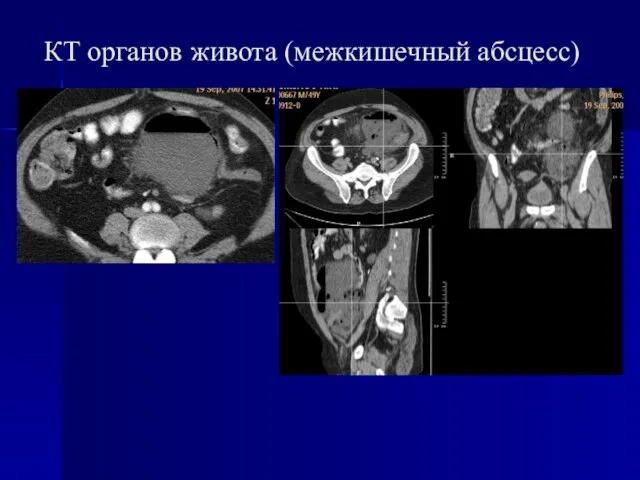 КТ органов живота (межкишечный абсцесс)