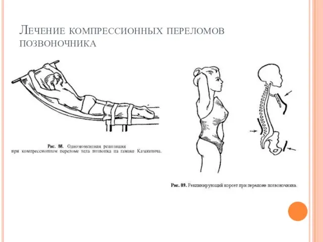 Лечение компрессионных переломов позвоночника