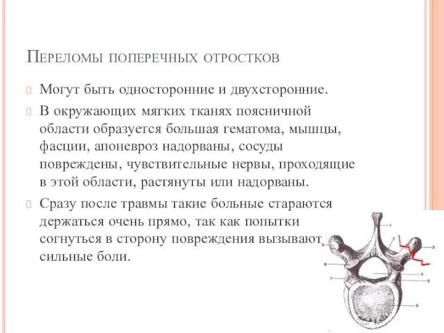 Переломы поперечных отростков Могут быть односторонние и двухсторонние. В окружающих мягких