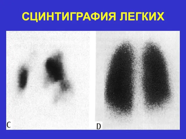 СЦИНТИГРАФИЯ ЛЕГКИХ