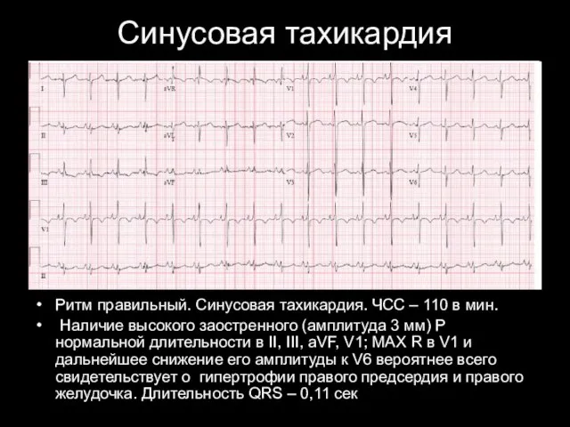 Синусовая тахикардия Ритм правильный. Синусовая тахикардия. ЧСС – 110 в мин.