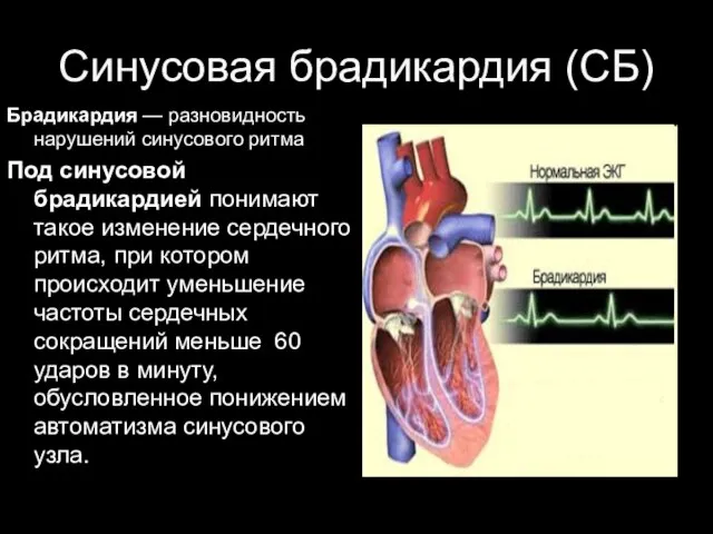 Синусовая брадикардия (СБ) Брадикардия — разновидность нарушений синусового ритма Под синусовой