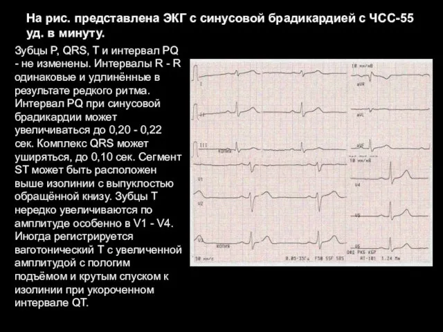 На рис. представлена ЭКГ с синусовой брадикардией с ЧСС-55 уд. в