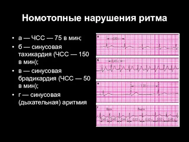 Номотопные нарушения ритма а — ЧСС — 75 в мин; б