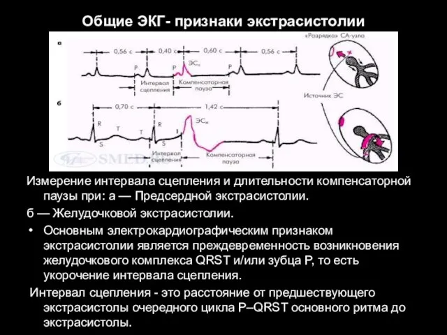 Общие ЭКГ- признаки экстрасистолии Измерение интервала сцепления и длительности компенсаторной паузы