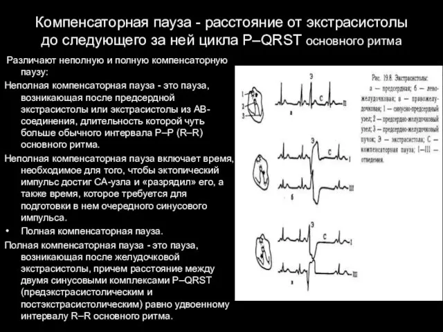 Компенсаторная пауза - расстояние от экстрасистолы до следующего за ней цикла