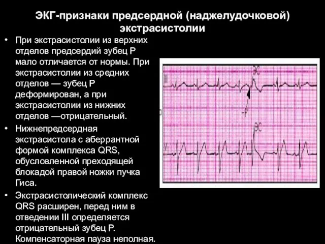 ЭКГ-признаки предсердной (наджелудочковой) экстрасистолии При экстрасистолии из верхних отделов предсердий зубец