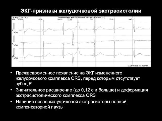 ЭКГ-признаки желудочковой экстрасистолии Преждевременное появление на ЭКГ измененного желудочкового комплекса QRS,