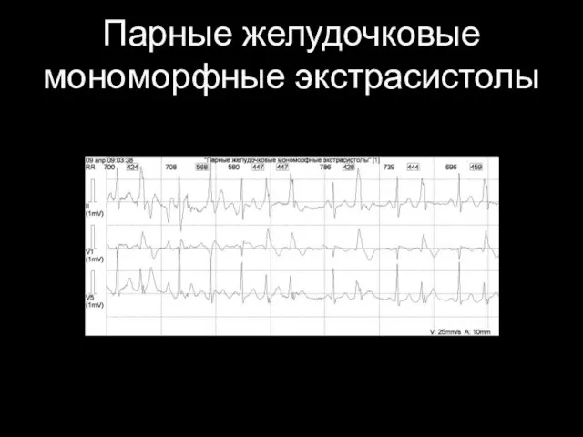 Парные желудочковые мономорфные экстрасистолы