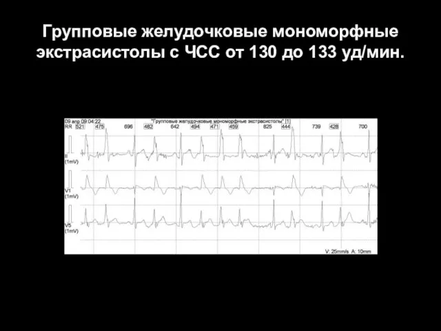 Групповые желудочковые мономорфные экстрасистолы с ЧСС от 130 до 133 уд/мин.