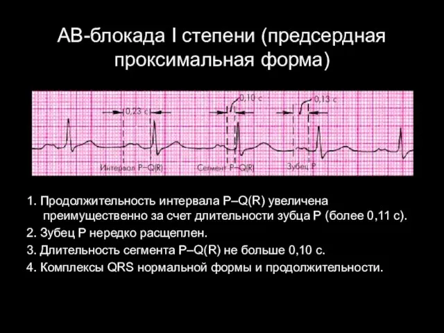 АВ-блокада I степени (предсердная проксимальная форма) 1. Продолжительность интервала P–Q(R) увеличена