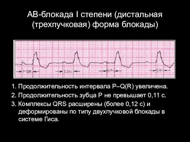 АВ-блокада I степени (дистальная (трехпучковая) форма блокады) 1. Продолжительность интервала P–Q(R)