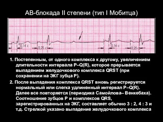 АВ-блокада II степени (тип I Мобитца) 1. Постепенным, от одного комплекса