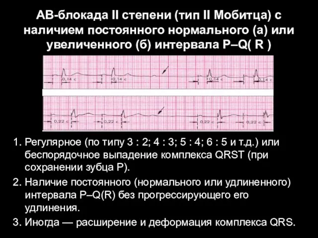 АВ-блокада II степени (тип II Мобитца) с наличием постоянного нормального (а)