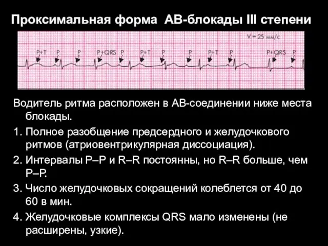 Проксимальная форма АВ-блокады III степени Водитель ритма расположен в АВ-соединении ниже