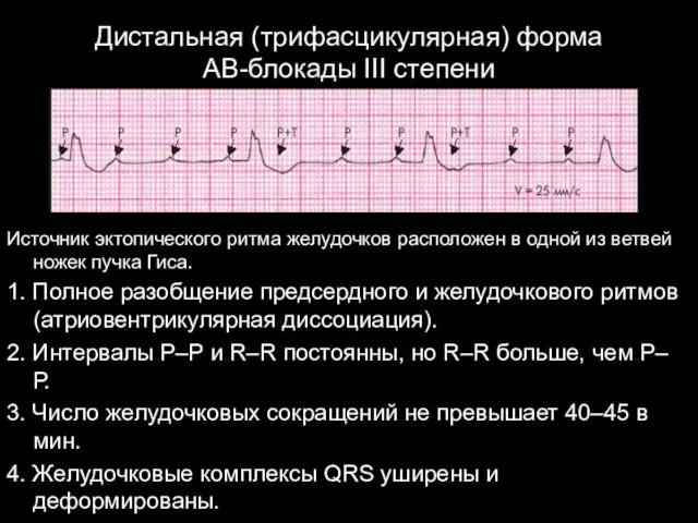 Дистальная (трифасцикулярная) форма АВ-блокады III степени Источник эктопического ритма желудочков расположен