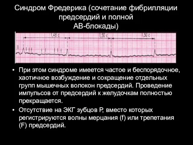 Синдром Фредерика (сочетание фибрилляции предсердий и полной АВ-блокады) При этом синдроме