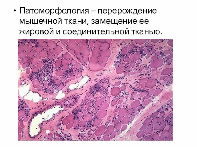 Патоморфология – перерождение мышечной ткани, замещение ее жировой и соединительной тканью.