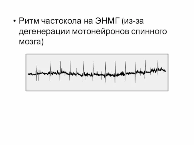 Ритм частокола на ЭНМГ (из-за дегенерации мотонейронов спинного мозга)