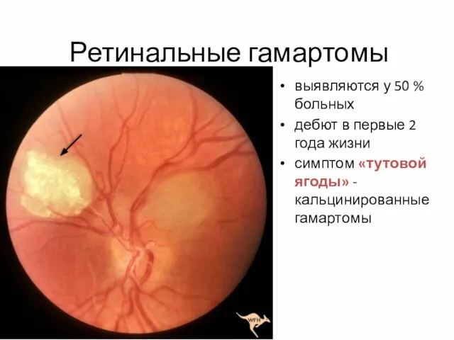 Ретинальные гамартомы выявляются у 50 % больных дебют в первые 2