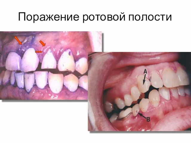 Поражение ротовой полости